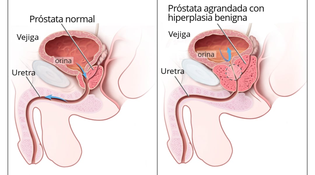 Hiperplasia Prostática Benigna