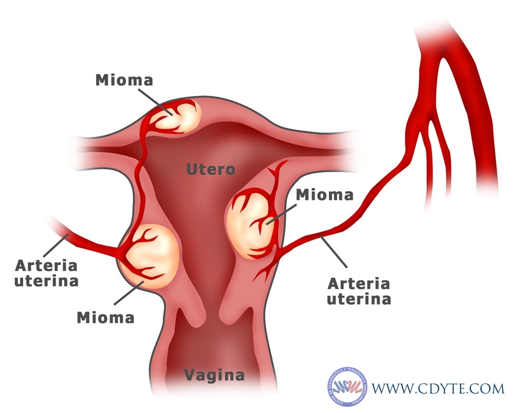 Mioma Uterino